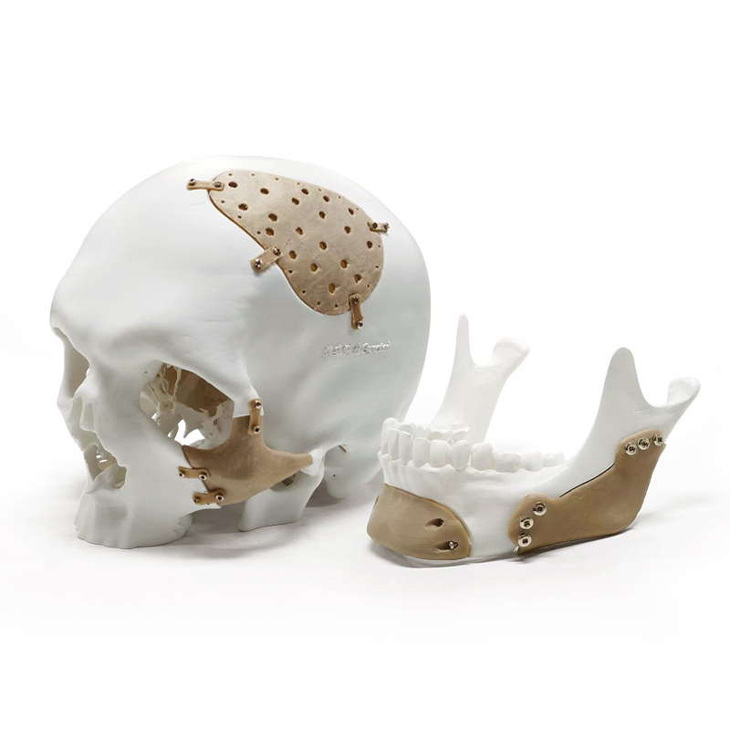PEEK Craniomaxillofacial Repair Case Model